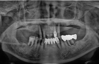 Before - Full Mouth Rehabilitation Implant