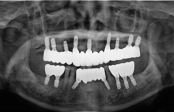After - Full Mouth Rehabilitation Implant
