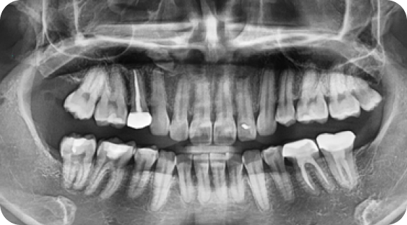 Wisdom Tooth 04