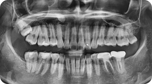 Wisdom Tooth 04