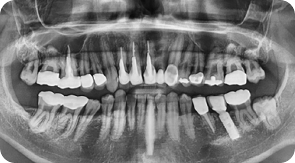 Wisdom Tooth 05