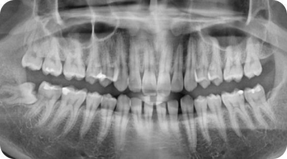 Wisdom Tooth 06