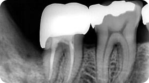Root Canal 01