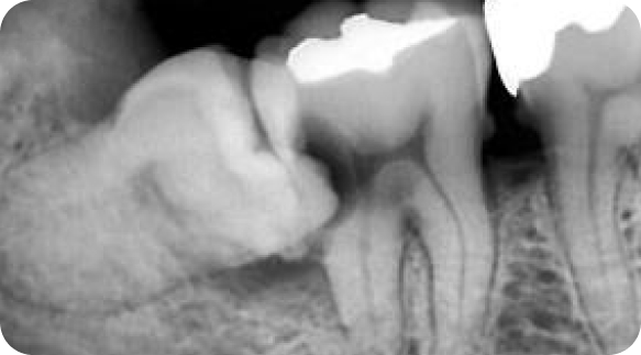 Root Canal 01