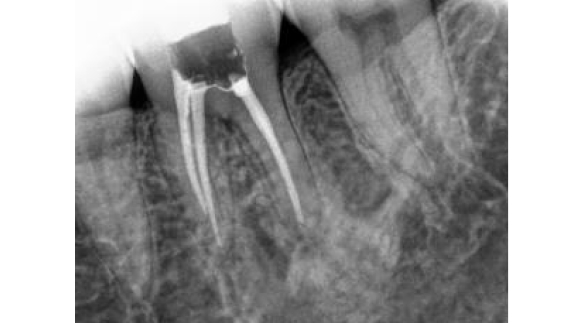Root Canal 02