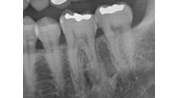 Root Canal 02