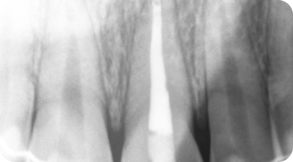 Root Canal 03