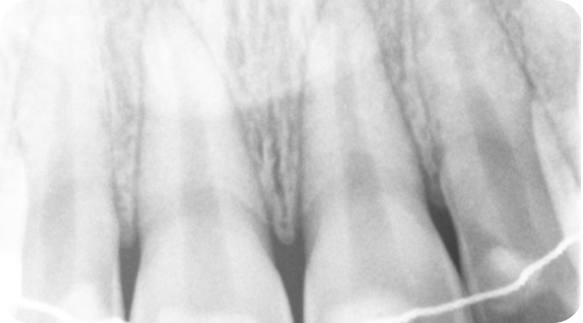 Root Canal 03