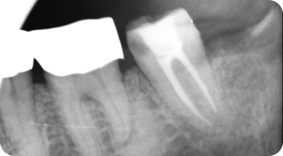 Root Canal 04