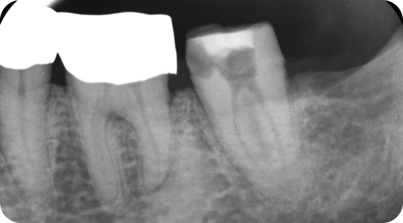 Root Canal 04