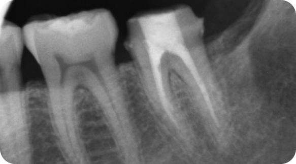 Root Canal 05
