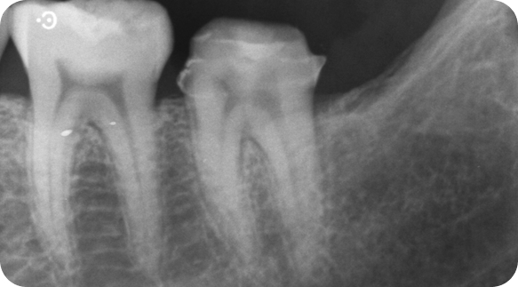 Root Canal 05