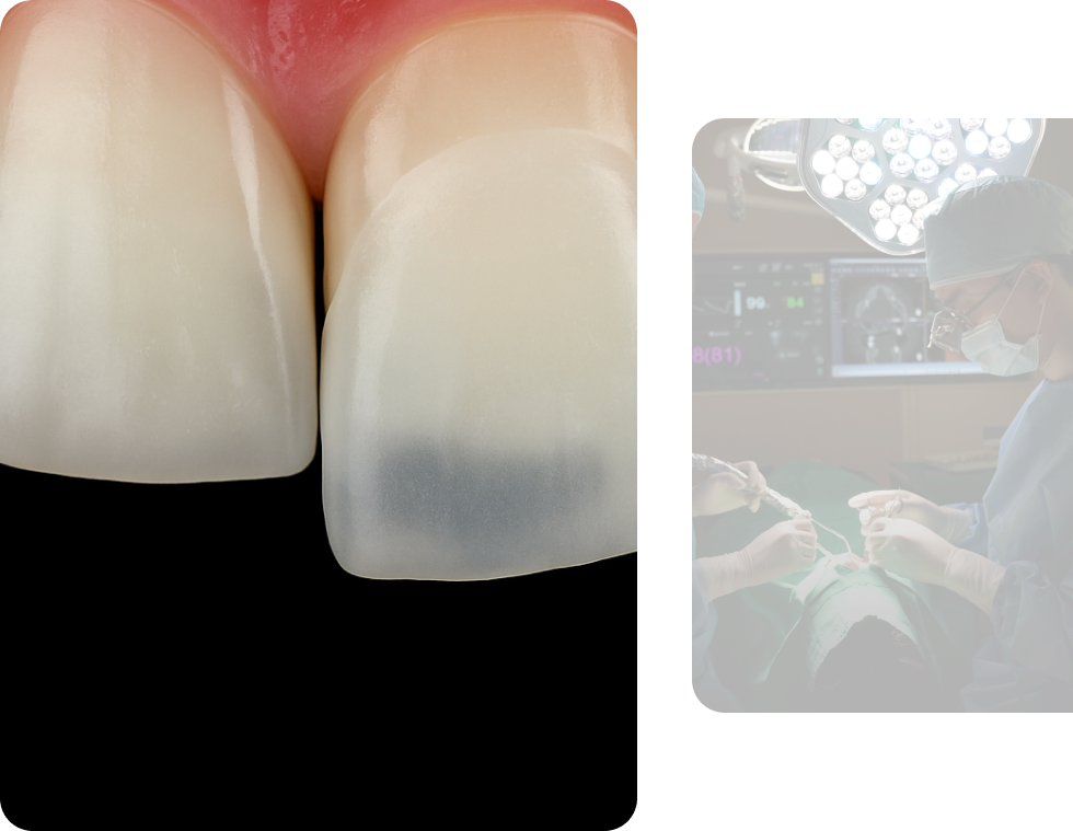No-Prep Veneer