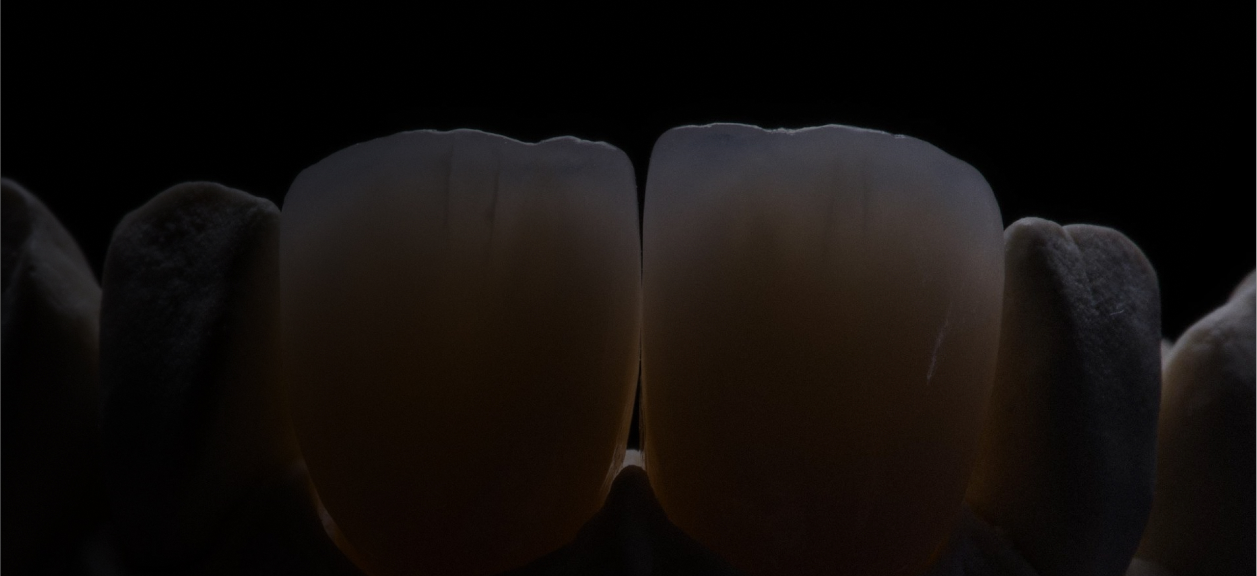 Premium veneers built on detail