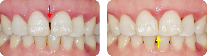 Front Tooth Resin