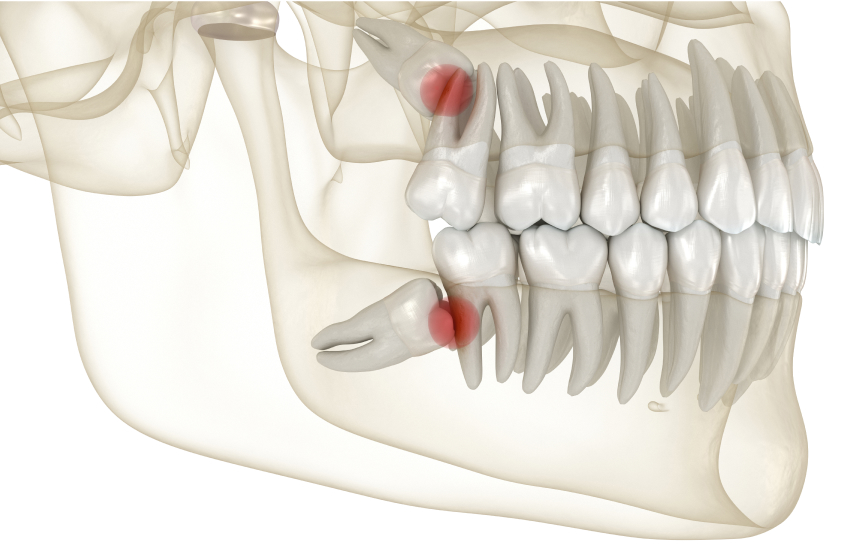 Same-Day Wisdom Tooth