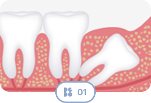 Wisdom Tooth Type 1