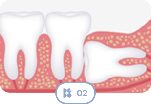 Wisdom Tooth Type 2