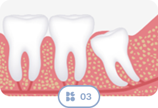 Wisdom Tooth Type 3