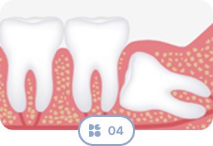 Wisdom Tooth Type 4