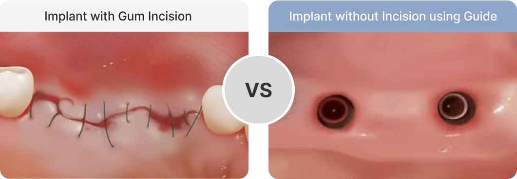 Flapless Implant