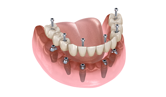 Full-Arch Implant