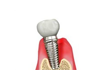 Implant Revision