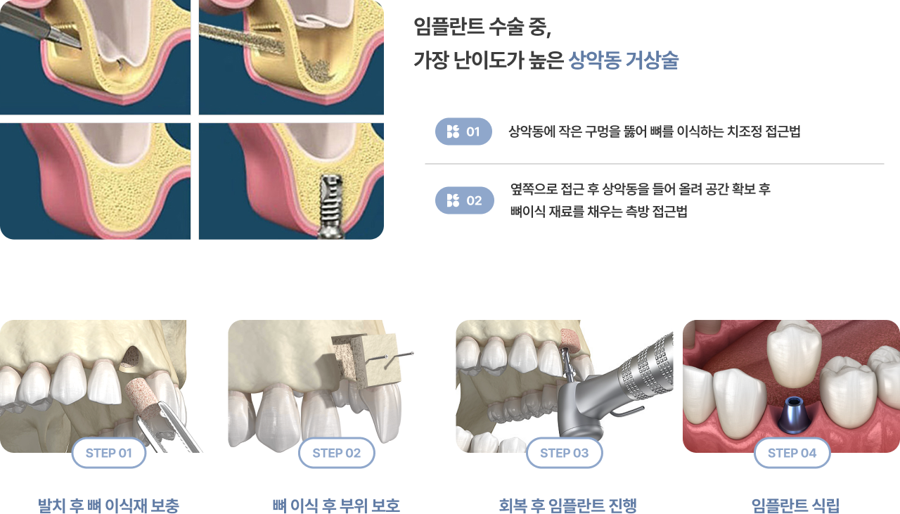 상악동 거상술